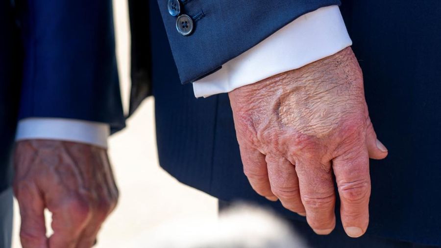  Make-up partially covers the back of the right hand of U.S. President Donald Trump as he speaks to members of the media upon his arrival from Pennsylvania, at Joint Base Andrews, Maryland, U.S., July 15, 2025. In a July 17, 2025 press briefing, U.S. Press Secretary Karoline Leavitt read a statement from his doctor that President Trump has a chronic venous insufficiency