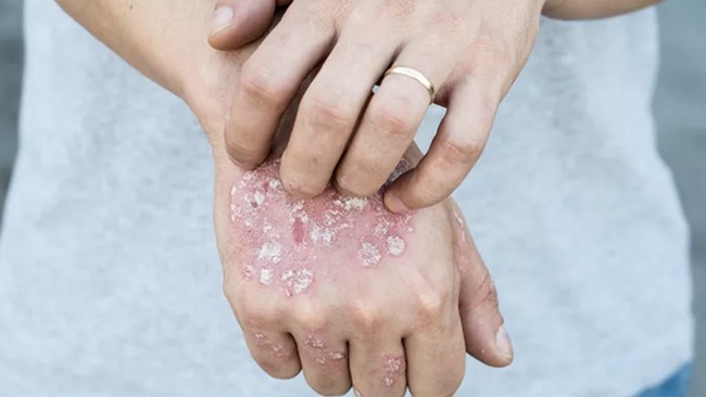 Indonesia Ranking 3 Dunia Penyakit Kusta, Ada 16.000 Kasus