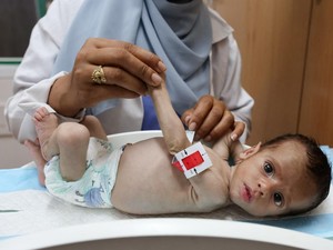 Mengenaskannya Bayi di Gaza Alami Malnutrisi, Lengan Hanya Sebesar Ibu Jari