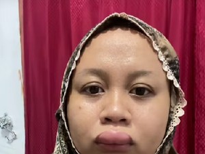 Bibirnya Bengkak Parah 3 Jam Sebelum Akad Nikah, Wanita Ini Viral di Medsos