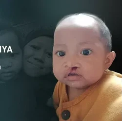 Khalisa, Balita Sumbing Ingin Tersenyum Lebih Indah Seperti yang Lain