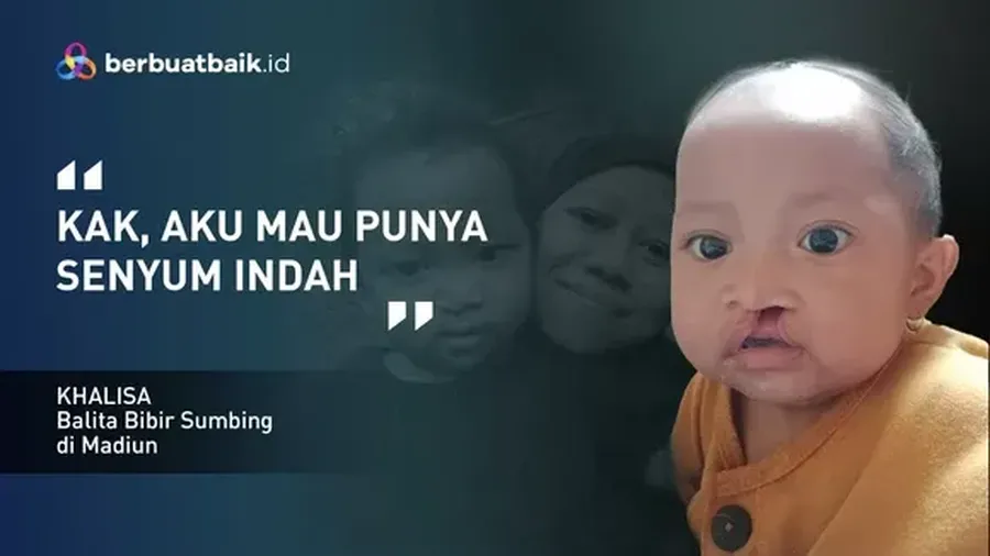 Khalisa Aiza Naadhira, balita mungil berusia 18 bulan, terlahir dengan kondisi bibir sumbing. (Dok. Berbuatbaik.id)