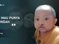 Khalisa, Balita Sumbing Ingin Tersenyum Lebih Indah Seperti yang Lain