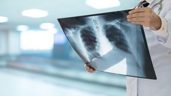 Dokter Paru Jelaskan Kaitan Campak dengan Pneumonia yang Lumpuhkan Paru-paru