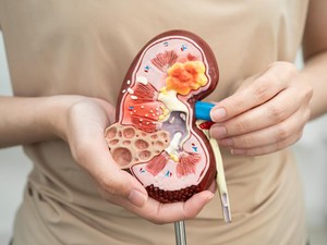 5 Kebiasaan yang Bisa Tingkatkan Risiko Batu Ginjal, Punya Salah Satunya?