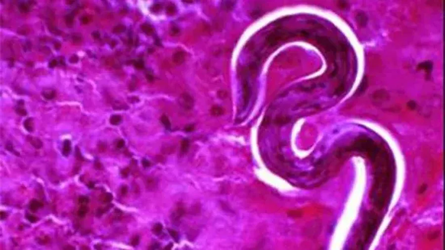 Ilustrasi Ascariasis. (Dok. maynoothuniversity)