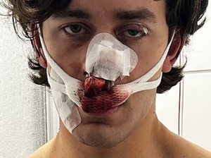 Model Ditikam Saat Bela Wanita, Wajah Luka Parah Hingga Hidung Terbelah