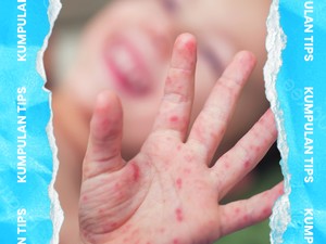 Video KuTips: Terapi Campak pada Anak, IDAI Ingatkan Isolasi Diri