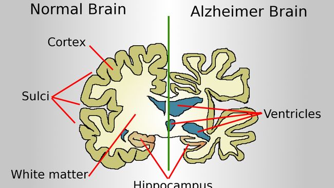 Studi Baru Ungkap Gaya Hidup yang Bisa Mengurangi Risiko Alzheimer