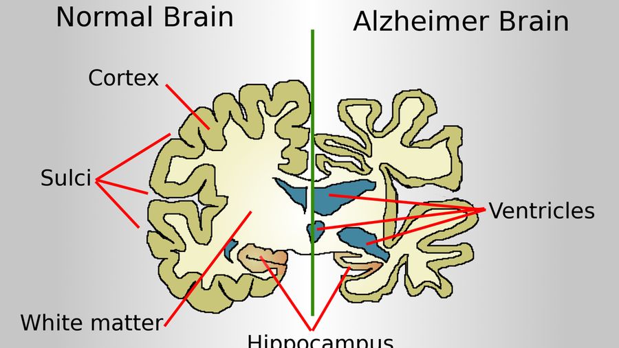 Ilustrasi alzheimer (Wikipedia)