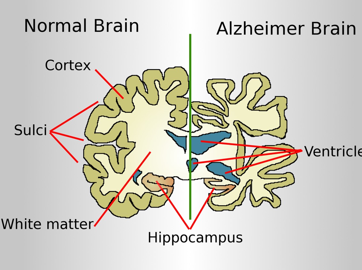 Telur dan AI Generatif: Cara Baru Kurangi Risiko Alzheimer Secara Efektif
