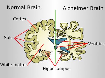 Ilmuwan Temukan Cara Tak Terduga Sembuhkan Penyakit Alzheimer