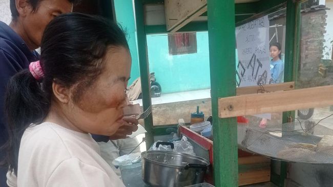 Kisah Resti Ridiyanti, Anak Tukang Batagor yang Menderita Tumor