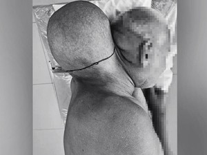Cerita Pria Punya Tumor Raksasa Sebesar Kepala, Tolak ke RS Selama 16 Tahun