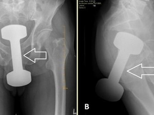 Kisah Dokter Keluarkan Dumbell 2,2 Kg yang Nyangkut di Anus Pria