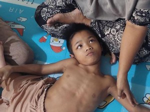 Kisah Pilu Hadijah, Penderita Cerebral Palsy yang Ditelantarkan Ibu