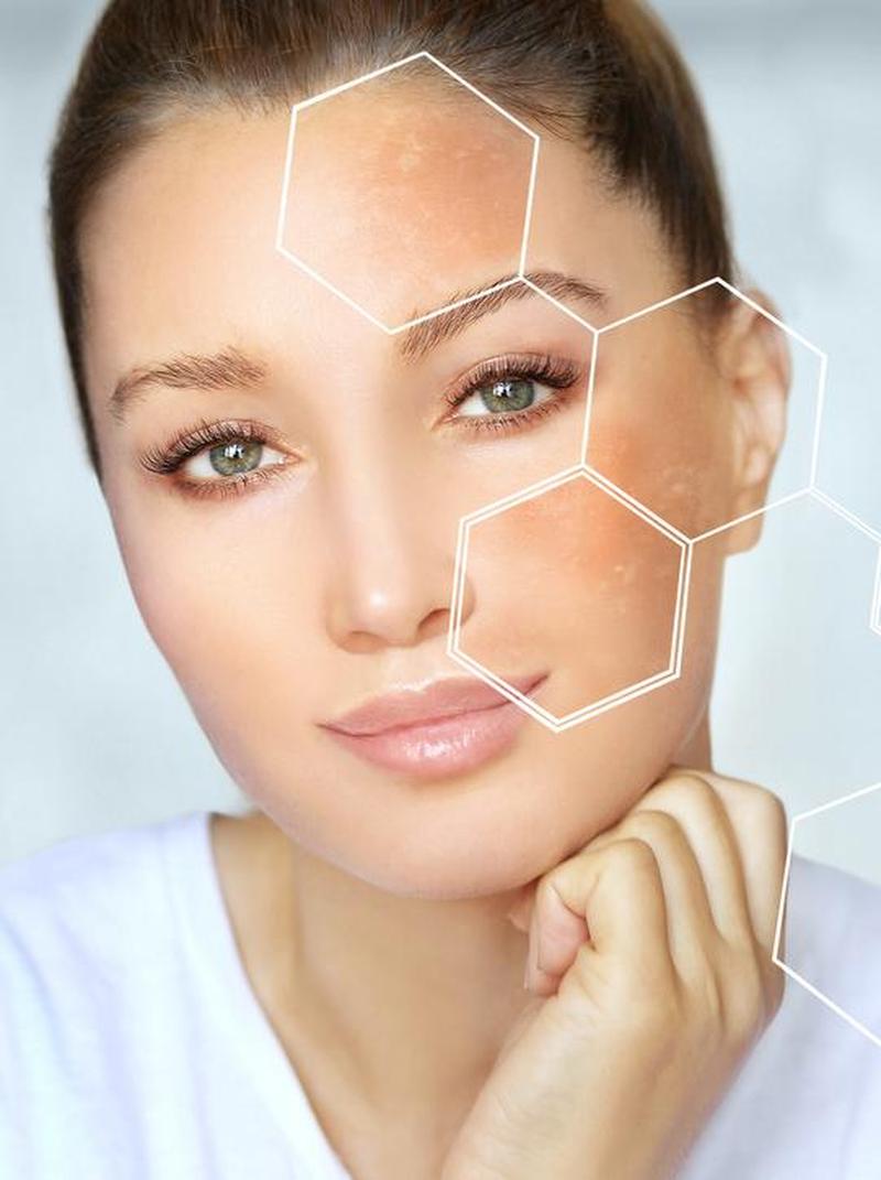 Sering Jerawatan & Kemerahan? Bisa Jadi Radang Kulit, Ini Solusinya