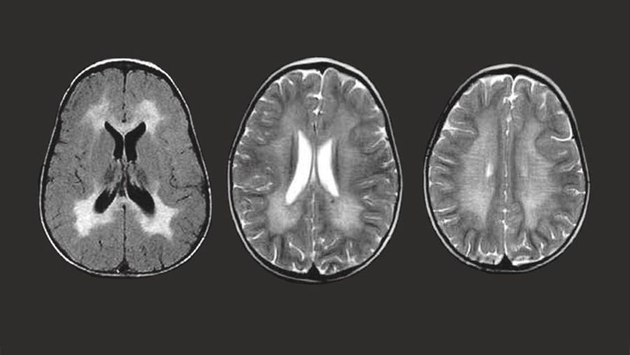 Penyakit Metachromatic Leukodystrophy. (Dok. mldsupportuk)