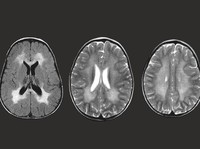 Apa Itu Penyakit Gangguan Genetik MLD yang Harga Obatnya Rp70,5 M?