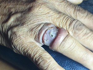 Cincin Tertanam di Jari, Nenek Minta Bantuan Damkar Denpasar