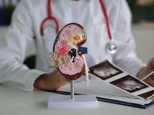 5 Makanan yang Ternyata Diam-diam Memicu Batu Ginjal