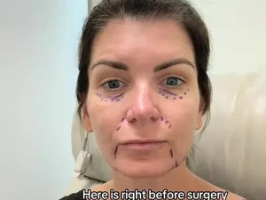 Habiskan Rp 1,2 M untuk Facelift, Wanita Ini Kena Mental Lihat Hasilnya