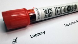 Kronologi WNI di Rumania Terkena Kusta, Jadi Kasus Pertama usai 44 Tahun