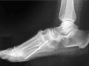 Awal Mula Dokter Temukan Besi Nancap di Dalam Kaki Pasien Setelah 40 Tahun