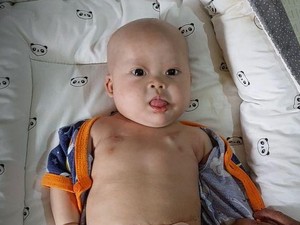 Kisah Chiara Bayi Penderita Tumor Teratoma Immature, Berjuang Ingin Sembuh