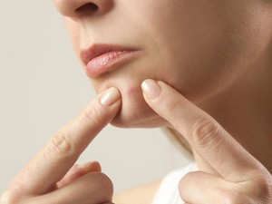 Mengenal 6 Hormon Penyebab Jerawat dan Cara Mengobatinya