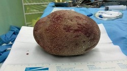 Penampakan Batu Kandung Kemih Bak Telur Raksasa, Beratnya Hampir 1 Kg