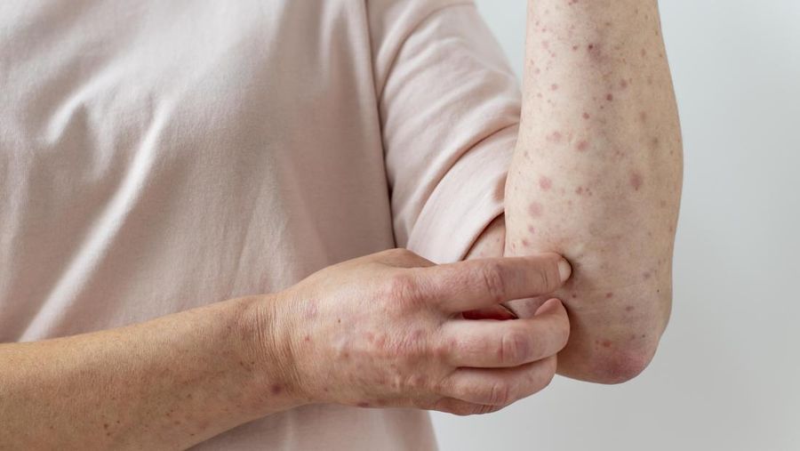 Varicella-zoster virus. (Dok. Freepik)