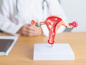 PCOS Berganti Nama Menjadi PMOS, Apa Bedanya? Ini Penjelasan Obgyn