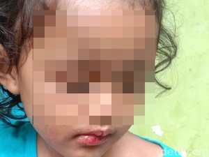 Fakta-fakta Balita di Surabaya Dianiaya Paman dan Bibi hingga Kepala Botak