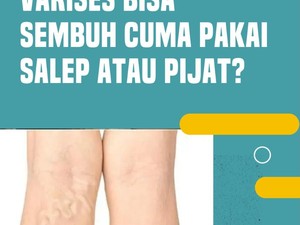 Video Benarkah Varises Bisa Sembuh dengan Salep atau Pijat?
