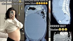 Viral Wanita Surabaya Idap Kista Sebesar 33 Cm, Inikah Pemicunya?
