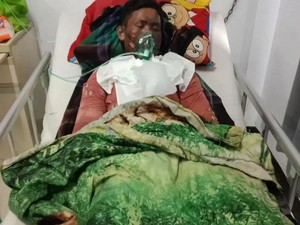Anak yang Dibakar Ibu Kandung di Sumbawa Meninggal Dunia