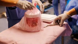 Rekor Terlama, Pria AS Hidup 271 Hari dengan Ginjal Babi sebelum Terima Donor Manusia