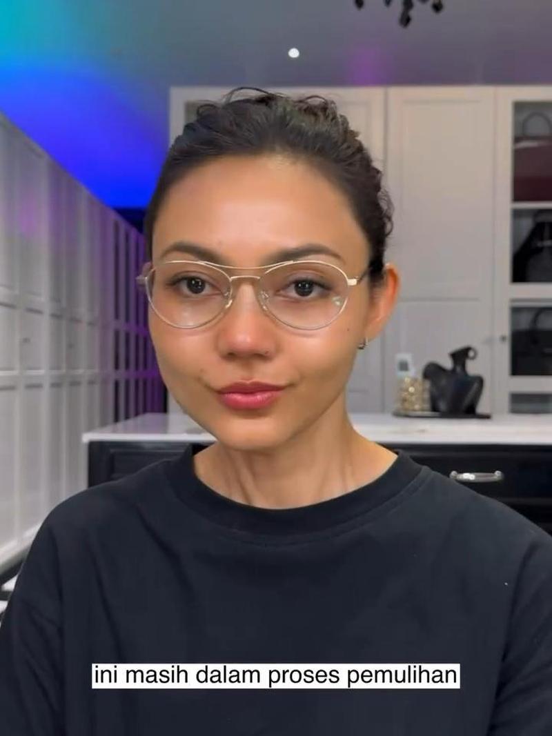Cerita Rina Nose Operasi Hidung Pakai Tulang Iga, Bikin Wajah Jadi Ningrat