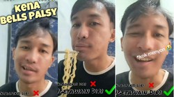 Viral Pria Idap Bells Palsy, Bikin Mulutnya Miring ke Satu Sisi