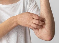 Penyakit Ini Lebih Menular dari Covid, 1 Orang Tularkan 18 Lainnya