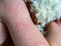 Kenali Gejala, Penularan dan Cara Mencegah Penyakit Campak pada Anak