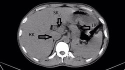 Penampakan Ginjal Ketiga pada Pria India, Bentuknya Mirip Tapal Kuda