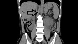 Pria 31 Tahun Niat Berobat gegara ISK Parah, Dokter Malah Temukan Ginjal Ketiga