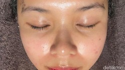 Video: Buccal Facial Contour yang Bikin Wajah Kayak Habis Botox