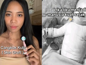 Kronologi Wanita Bali Transplantasi Kulit usai Hampir Seluruh Tubuh Kena Luka Bakar