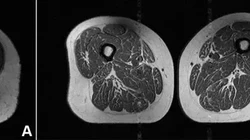 Potret Makanan UPF Bikin Paha Manusia Mirip Daging Berlemak, Seserius Ini Efeknya