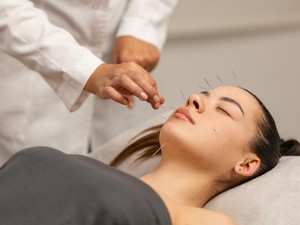 Tren Baru! Akupuntur Wajah Jadi Alternatif Botox Tanpa Suntik