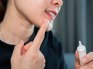 Benarkah Benzolac Ampuh Atasi Jerawat dan Bekasnya?