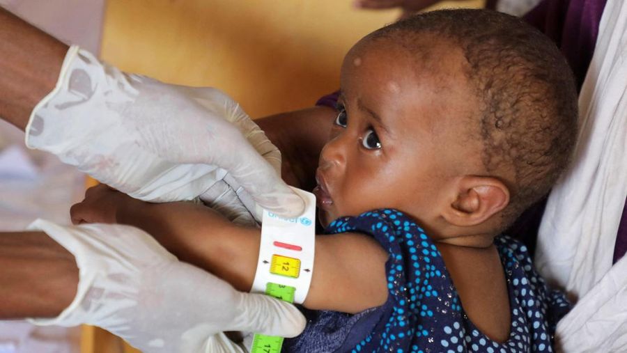 Seorang anak pengungsi internal Somalia diperiksa gizinya selama kunjungan Wakil Sekretaris Jenderal PBB untuk Urusan Kemanusiaan dan Koordinator Bantuan Darurat Tom Fletcher (tidak terlihat dalam foto), karena kekurangan makanan terapeutik yang menyelamatkan jiwa akibat gangguan pengiriman karena perang Iran telah memaksa klinik yang merawat anak-anak yang kekurangan gizi parah untuk menolak pasien dan membatasi persediaan di Somalia yang dilanda kekeringan, di sebuah kamp di pinggiran Mogadishu, Somalia, 28 April 2026.